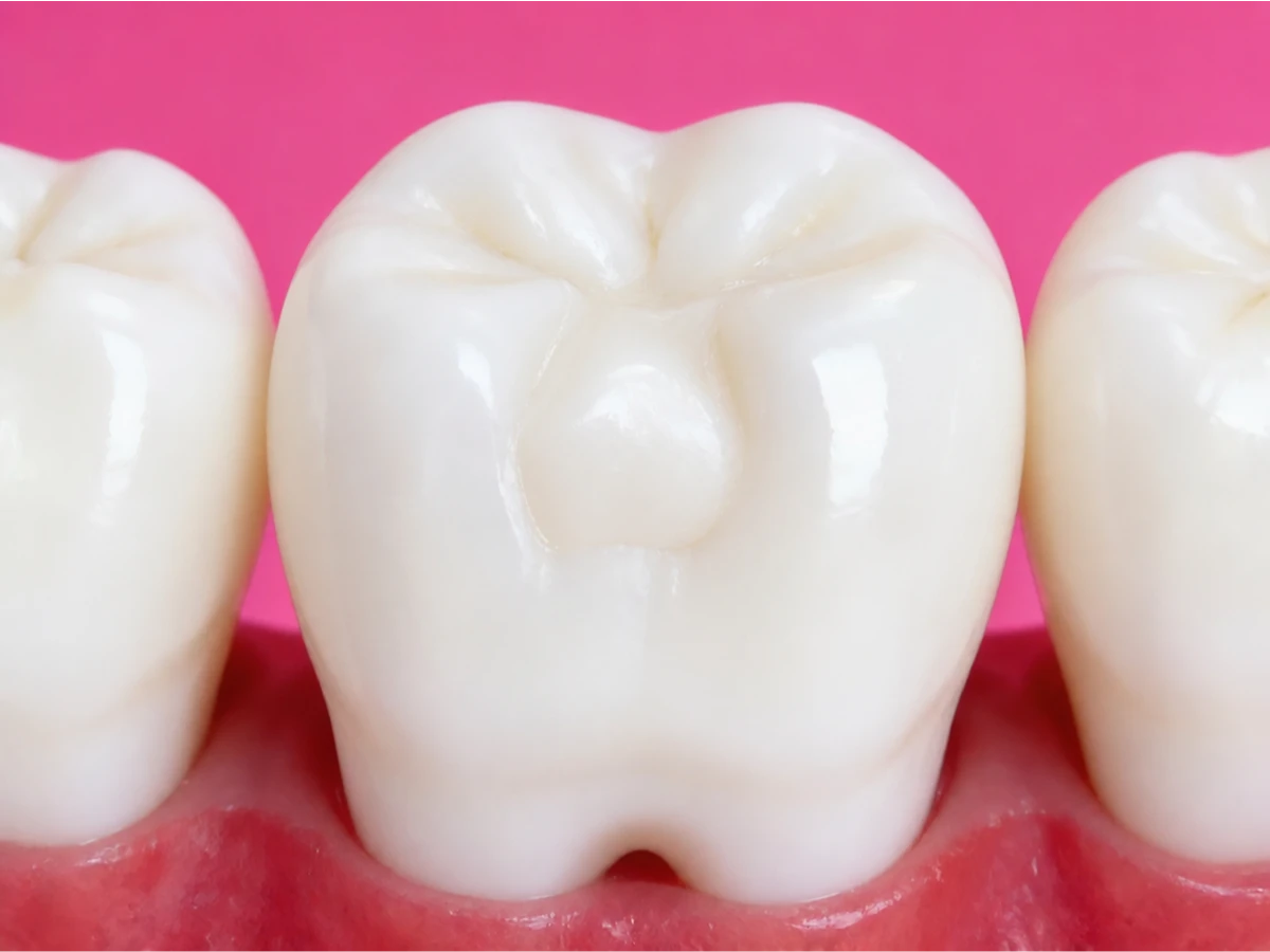 Composite Bonding in Abbotsford, BC at Mount Lehman Dental