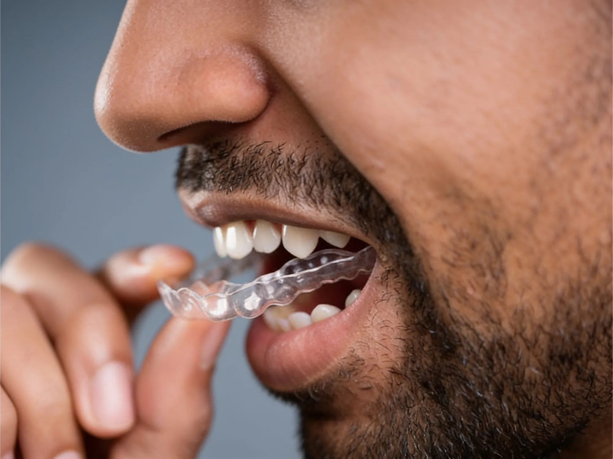 Night Guards & Teeth Grinding in Abbotsford, BC at Mount Lehman Dental